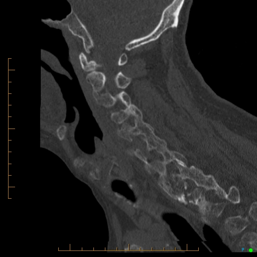 Cervical spine fracture - ankylosing spondylitis (Radiopaedia 76835-88706 Sagittal bone window 71).jpg