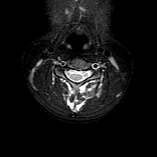 File:Cervical spine posterior ligamentous complex rupture (Radiopaedia 63486-72103 Axial T2 13).jpg