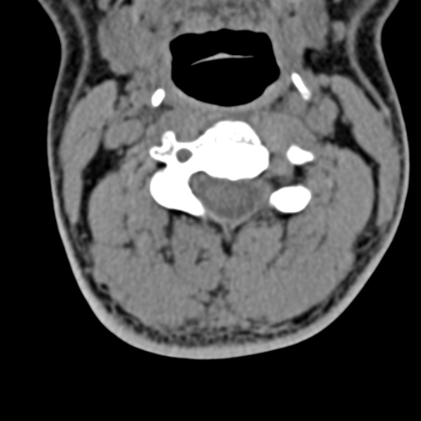 Cervical spondylodiscitis (Radiopaedia 28057-29489 Axial non-contrast 34).jpg