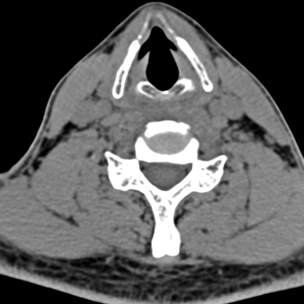 Cervical spondylodiscitis (Radiopaedia 28057-29489 Axial non-contrast 51).jpg