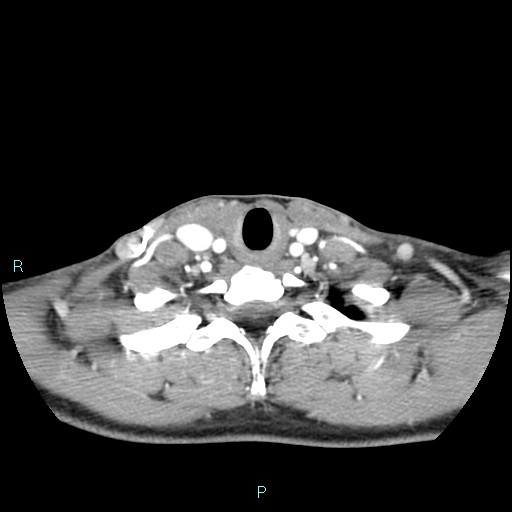 Cervical thymic cyst (Radiopaedia 88632-105335 B 36).jpg