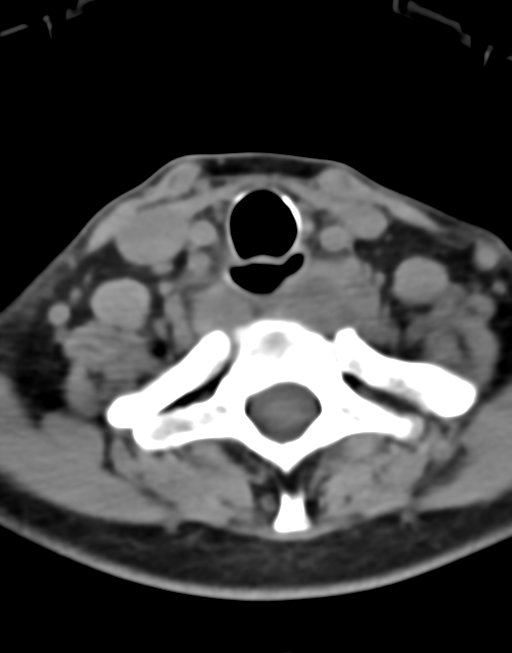 Cervical tuberculous spondylitis (Radiopaedia 39149-41365 Axial non-contrast 43).png