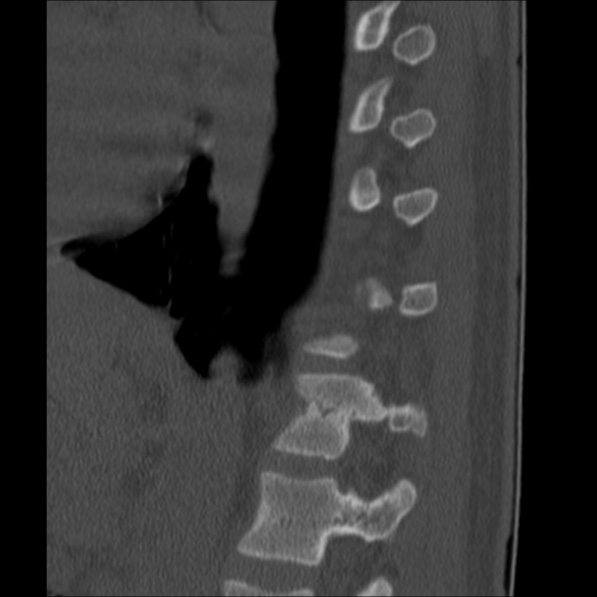 Chance fracture (Radiopaedia 36521-38081 Sagittal bone window 54).jpg