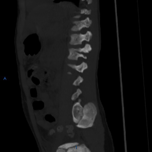 File:Chance fracture with duodenal and pancreatic lacerations (Radiopaedia 43477-50042 Sagittal bone window 3).jpg