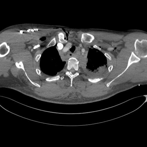 Chest multitrauma - aortic injury (Radiopaedia 34708-36147 A 52).png