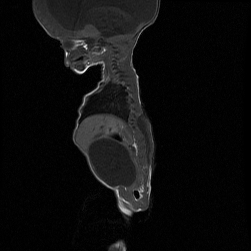File:Chiari II malformation with spinal meningomyelocele (Radiopaedia 23550-23652 Sagittal T1 8).jpg