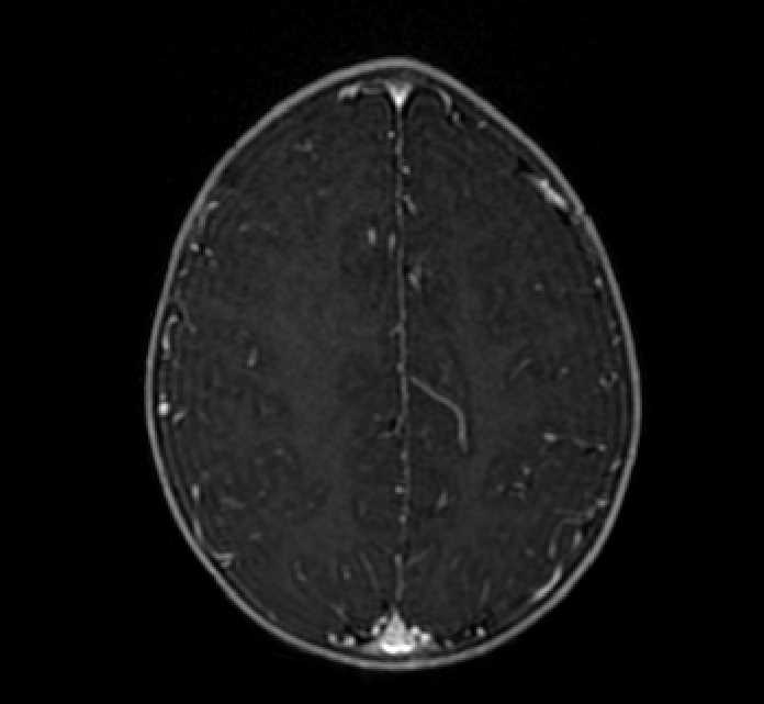 Chiasmatic-hypothalamic glioma (Radiopaedia 90079-107252 Axial T1 C+ 68).jpg