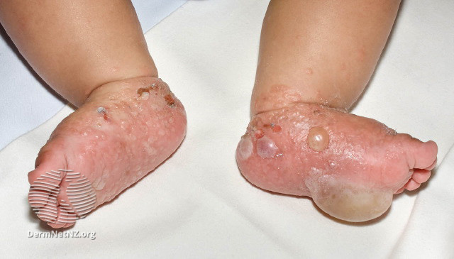 File:Childhood bullous pemphigoid (DermNet NZ immune-bullous-pemphigoid-1).jpg