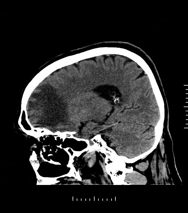 Cholangiocarcinoma with cerebral metastases (Radiopaedia 83519-98628 C 34).jpg