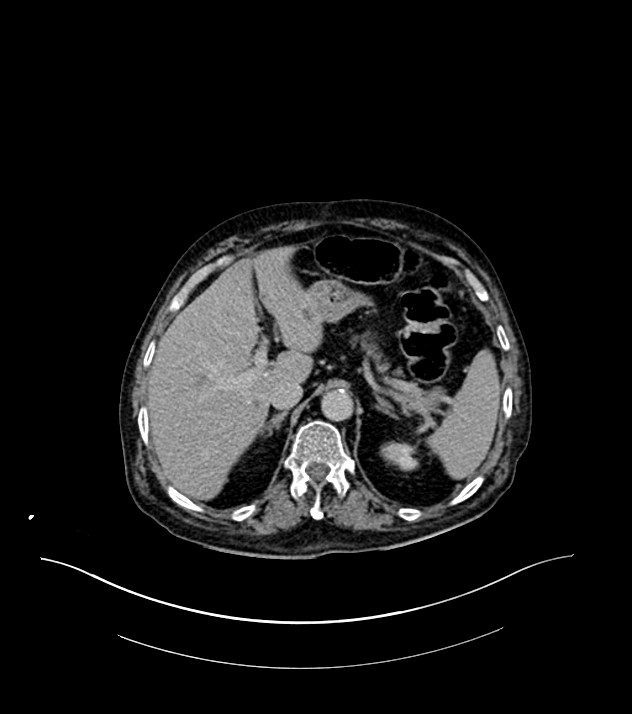 Cholangiocarcinoma with cerebral metastases (Radiopaedia 83519-98629 Axial C+ delayed 26).jpg