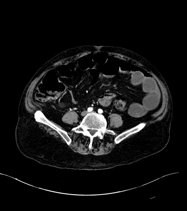 Cholangiocarcinoma with cerebral metastases (Radiopaedia 83519-98629 B 78).jpg