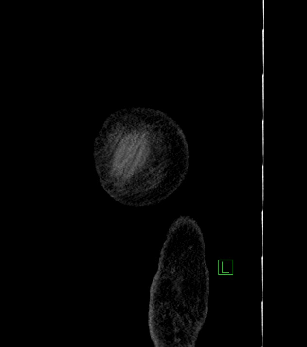Cholangiocarcinoma with cerebral metastases (Radiopaedia 83519-98629 F 3).jpg