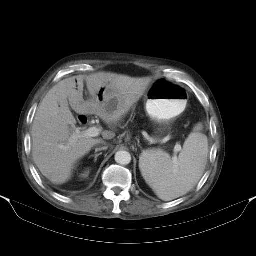 File:Cholangitis and abscess formation in a patient with cholangiocarcinoma (Radiopaedia 21194-21100 A 14).jpg