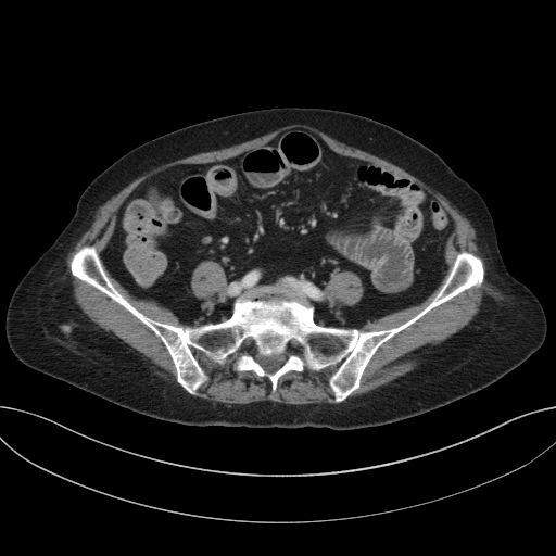 Cholecystoduodenal fistula due to calculous cholecystitis with gallstone migration (Radiopaedia 86875-103077 D 55).jpg
