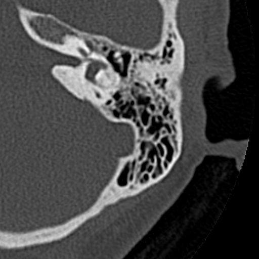File:Cholesteatoma of the external ear (Radiopaedia 16540-16225 Axial bone window 18).jpg