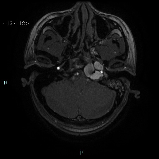 Cholesterol granuloma of the petrous apex (Radiopaedia 64358-73140 Axial TOF 3D 57).jpg