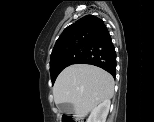 Chondrosarcoma - chest wall (Radiopaedia 65192-74199 B 44).jpg