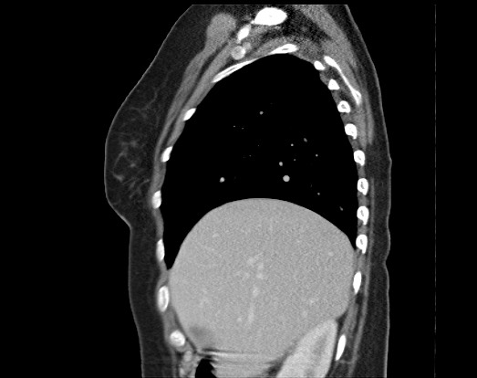 Chondrosarcoma - chest wall (Radiopaedia 65192-74199 B 46).jpg