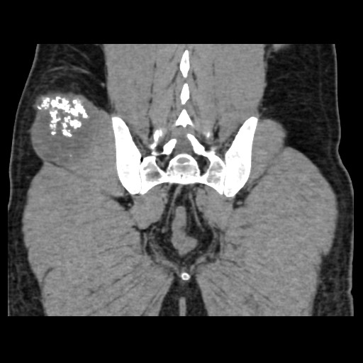 File:Chondrosarcoma of iliac wing (Radiopaedia 63861-72599 Coronal non-contrast 90).jpg
