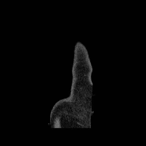 Chondrosarcoma of iliac wing (Radiopaedia 63861-72599 F 7).jpg