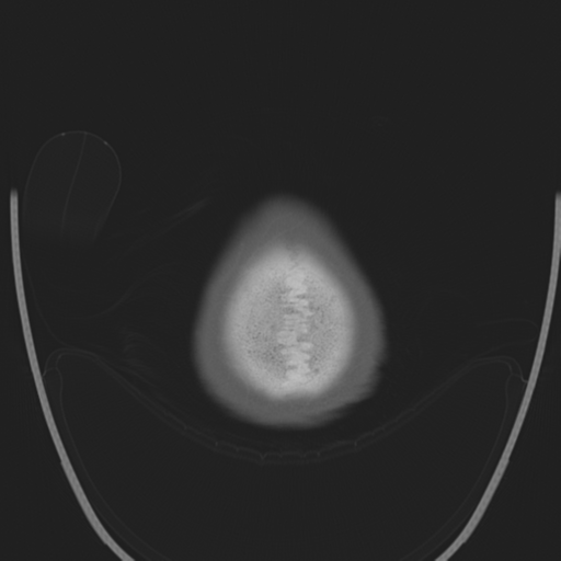 File:Chondrosarcoma of skull base- grade II (Radiopaedia 40948-43653 Axial bone window 50).png