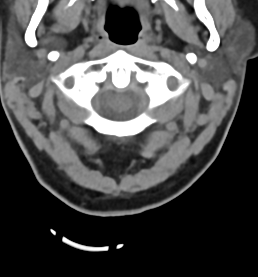 File:Chordoma (C4 vertebra) (Radiopaedia 47561-52188 Axial non-contrast 8).png