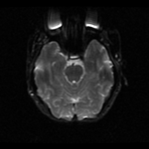 File:Choroid plexus xanthogranuloma (Radiopaedia 17650-17386 ADC 16).jpg