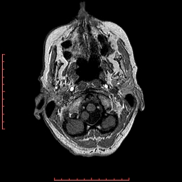File:Choroid plexus xanthogranuloma (Radiopaedia 67843-77270 Axial T1 149).jpg