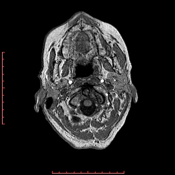 Choroid plexus xanthogranuloma (Radiopaedia 67843-77270 Axial T1 154).jpg