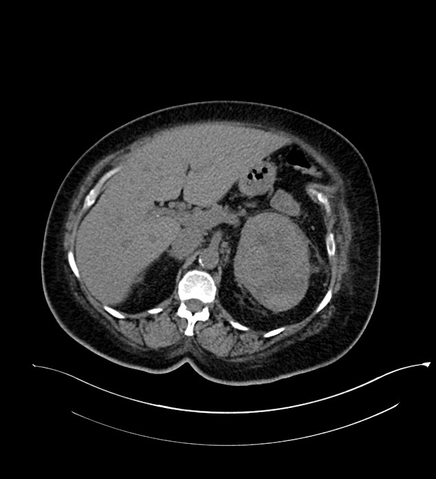 Chromophobe renal cell carcinoma (Radiopaedia 84239-99519 Axial non-contrast 58).jpg