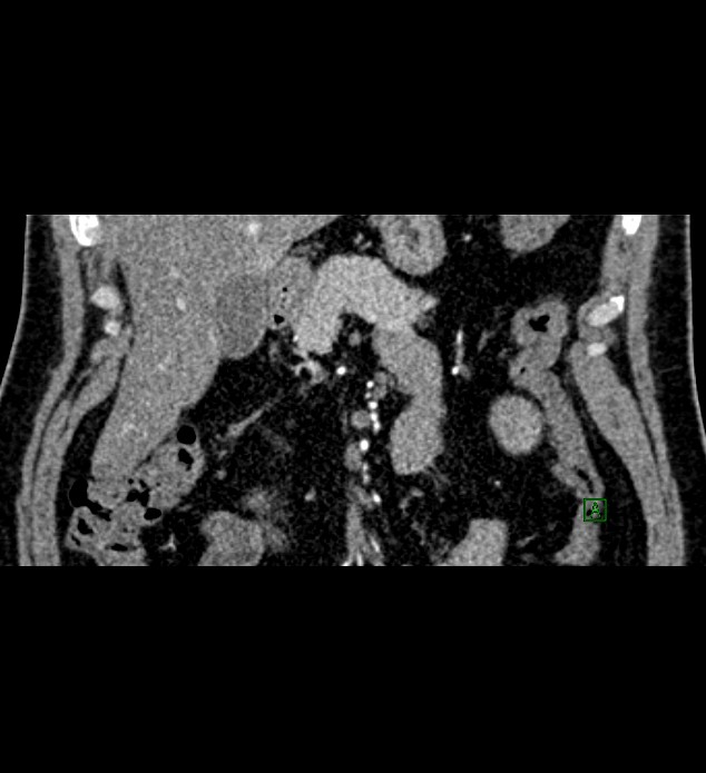 Chromophobe renal cell carcinoma (Radiopaedia 84286-99573 E 9).jpg