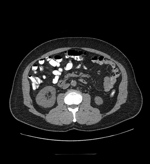 Chromophobe renal cell carcinoma (Radiopaedia 84337-99644 Axial non-contrast 50).jpg