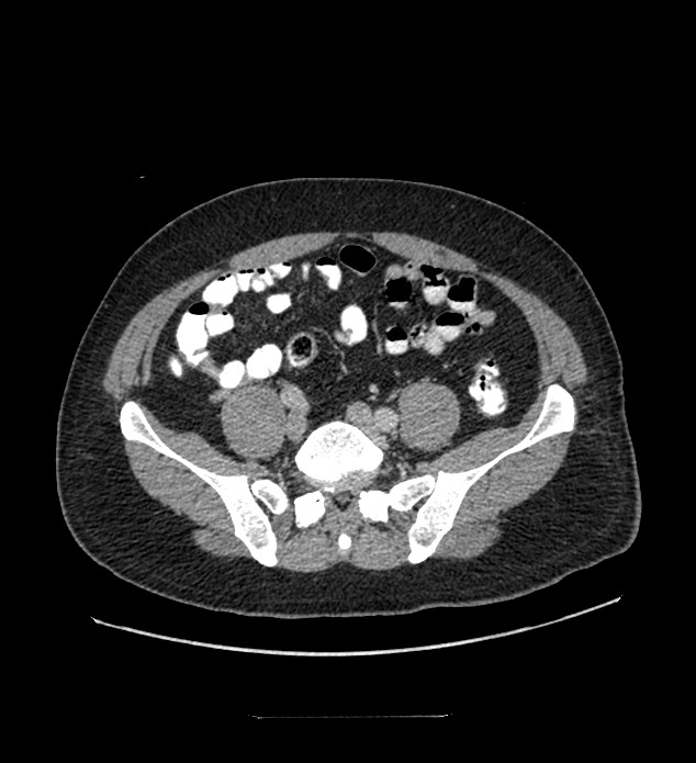 Chromophobe renal cell carcinoma (Radiopaedia 84337-99644 C 95).jpg