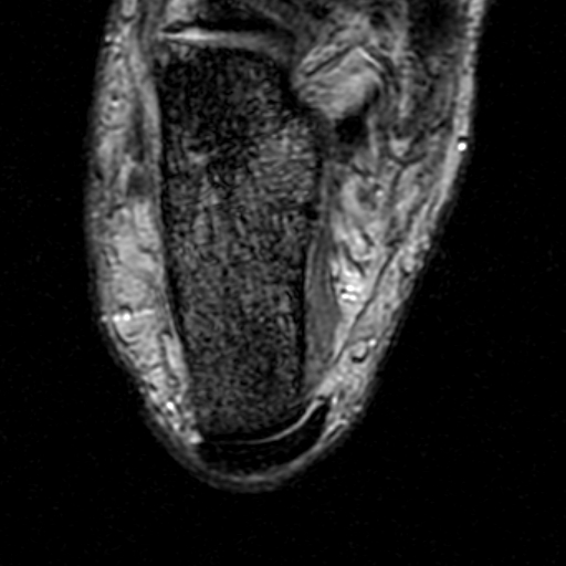File:Chronic Achilles tendon rupture (Radiopaedia 15262-15100 Axial Gradient Echo 22).jpg