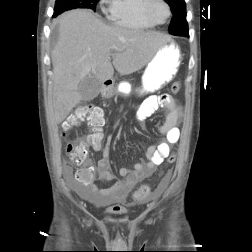 Chronic diverticulitis complicated by hepatic abscess and portal vein thrombosis (Radiopaedia 30301-30938 B 21).jpg