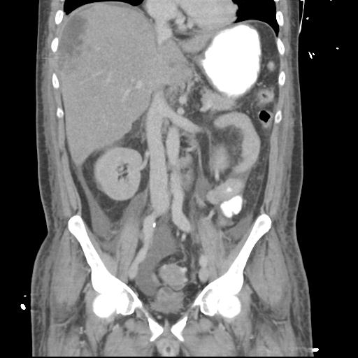 Chronic diverticulitis complicated by hepatic abscess and portal vein thrombosis (Radiopaedia 30301-30938 B 31).jpg