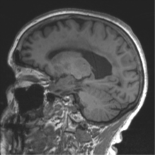 Chronic hypertensive encephalopathy (Radiopaedia 39993-42482 Sagittal T1 58).png