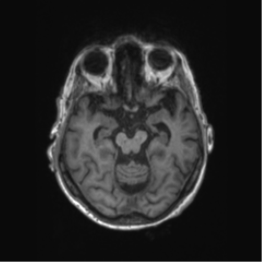 Chronic hypertensive encephalopathy (Radiopaedia 72844-83495 Axial T1 46).png