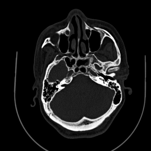 Chronic invasive fungal sinusitis (Radiopaedia 91563-109286 Axial sinus 43).jpg