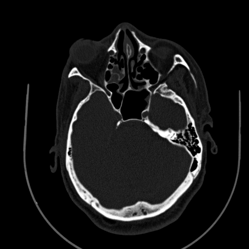 Chronic invasive fungal sinusitis (Radiopaedia 91563-109286 Axial sinus 64).jpg