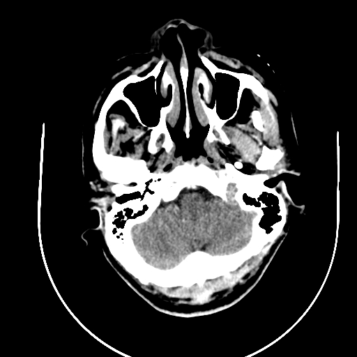 Chronic invasive fungal sinusitis (Radiopaedia 91563-109286 B 8).jpg