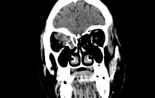 Chronic invasive fungal sinusitis (Radiopaedia 91563-109286 D 29).jpg