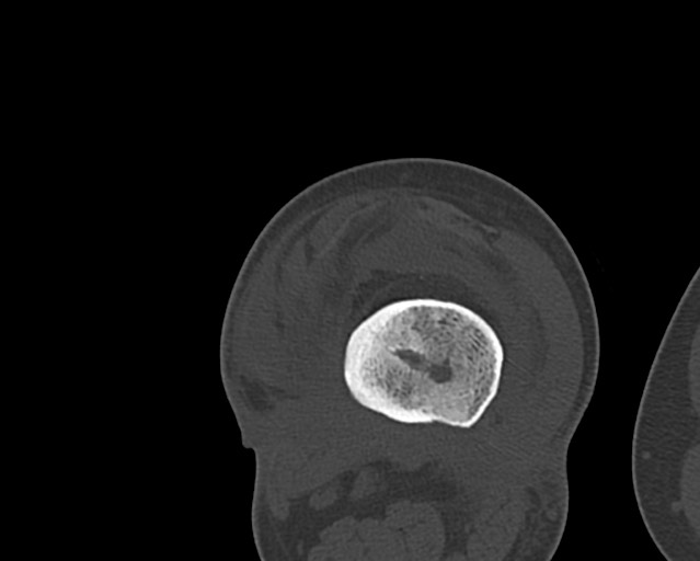 Chronic ostemyelitis of the femur with long sinus tract (Radiopaedia 74947-85982 Axial bone window 174).jpg