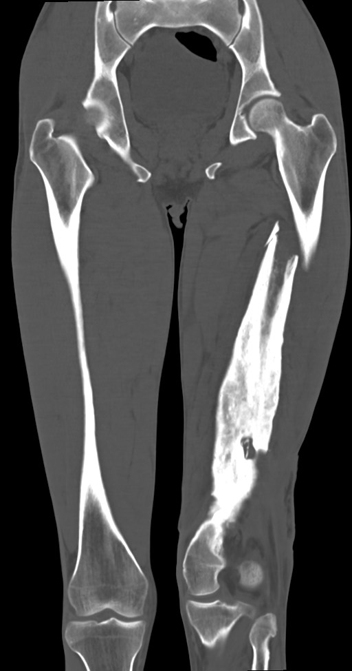 Chronic osteomyelitis (with sequestrum) (Radiopaedia 74813-85822 Coronal non-contrast 32).jpg