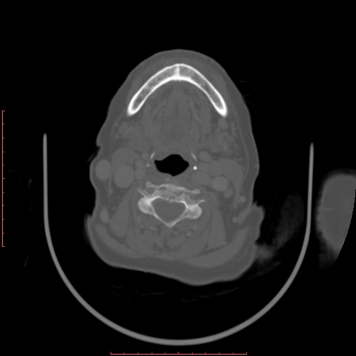 Chronic osteomyelitis - maxilla (Radiopaedia 23783-23927 Axial bone window 18).jpg