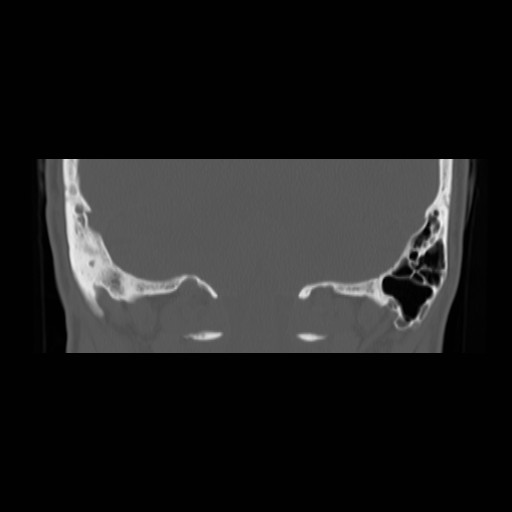 File:Chronic otomastoiditis (Radiopaedia 27138-27309 Coronal bone window 22).jpg
