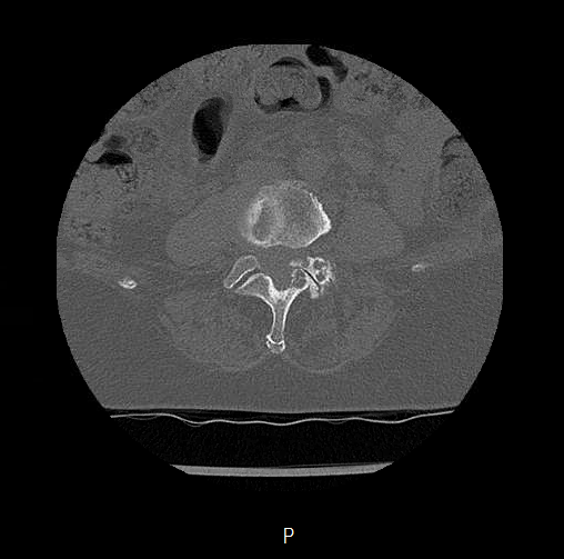 Chronic spinal hematoma with cauda equina syndrome (Radiopaedia 75745-88197 Axial bone window 39).png