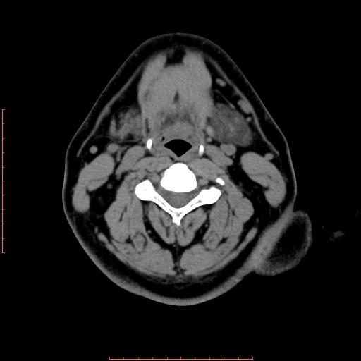 File:Chronic submandibular sialolithiasis (Radiopaedia 69817-79814 Axial non-contrast 132).jpg