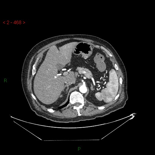 Circumaortic left renal vein and doubled left renal arteries (Radiopaedia 52268-58158 A 4).jpg