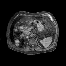 Cirrhosis and hepatocellular carcinoma in the setting of hemochromatosis (Radiopaedia 75394-86594 Axial T1 C+ fat sat 46).jpg